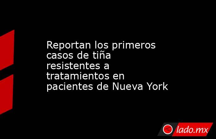 Reportan los primeros casos de tiña resistentes a tratamientos en pacientes de Nueva York. Noticias en tiempo real