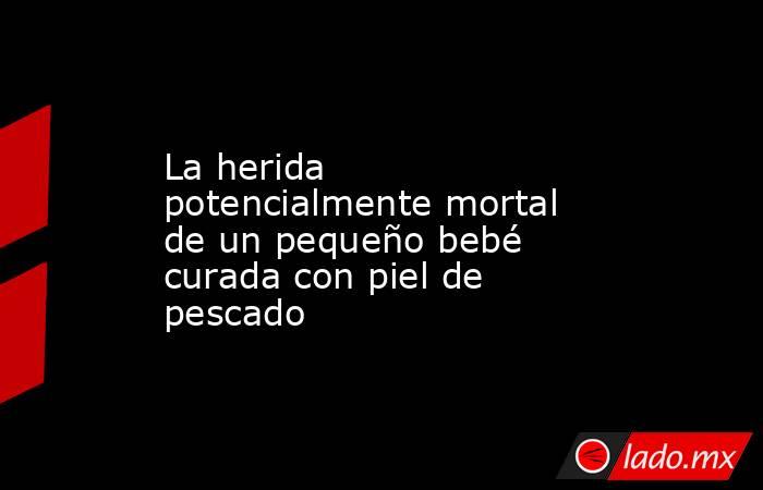 La herida potencialmente mortal de un pequeño bebé curada con piel de pescado. Noticias en tiempo real