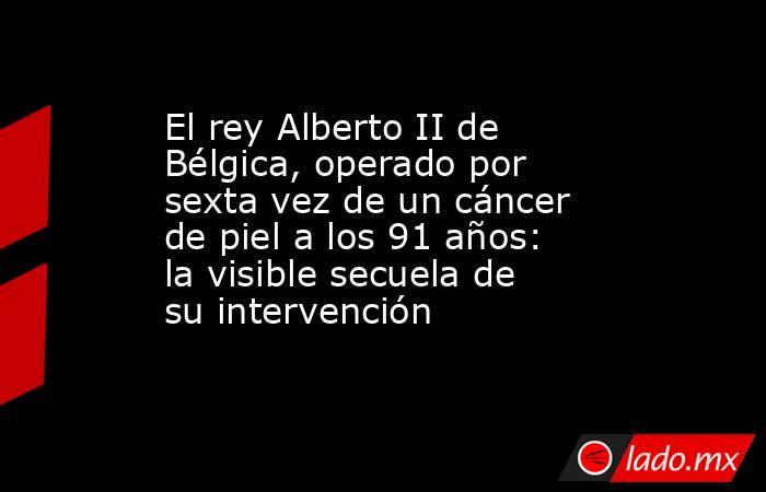 El rey Alberto II de Bélgica, operado por sexta vez de un cáncer de piel a los 91 años: la visible secuela de su intervención. Noticias en tiempo real